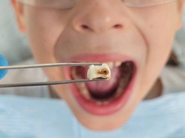 Best Emergency Tooth Extraction  in Fitzgerald, GA